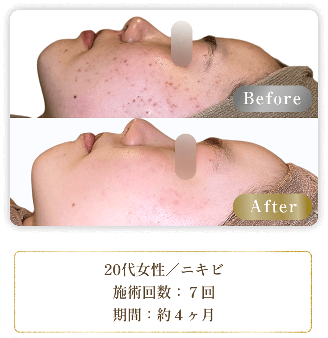 20代女性／ニキビ 施術回数：７回 期間：約４ヶ月