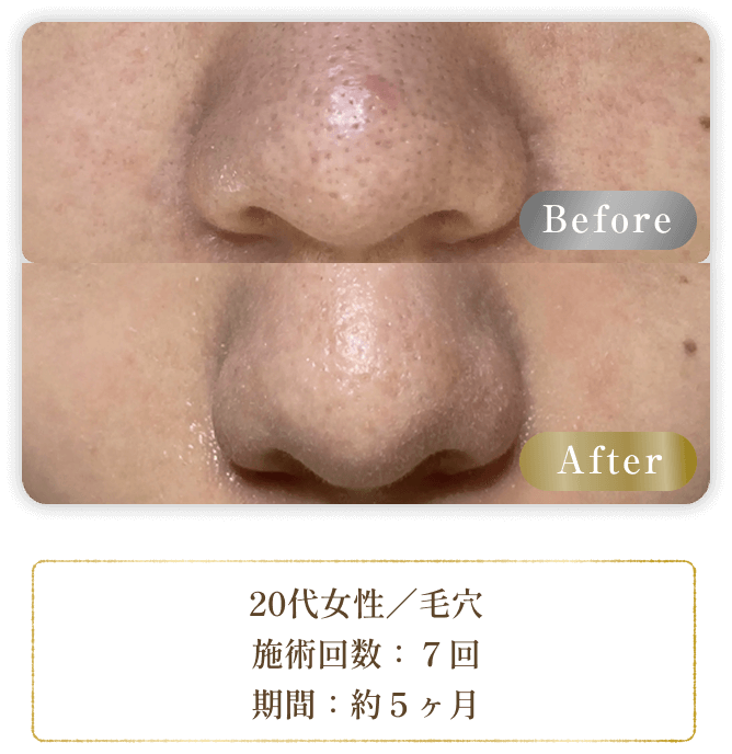 20代女性／毛穴 施術回数：７回 期間：約５ヶ月
